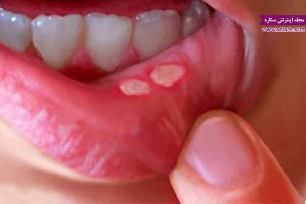 درمان خانگی زخم دهان (درمان آفت دهان با طب سنتی)